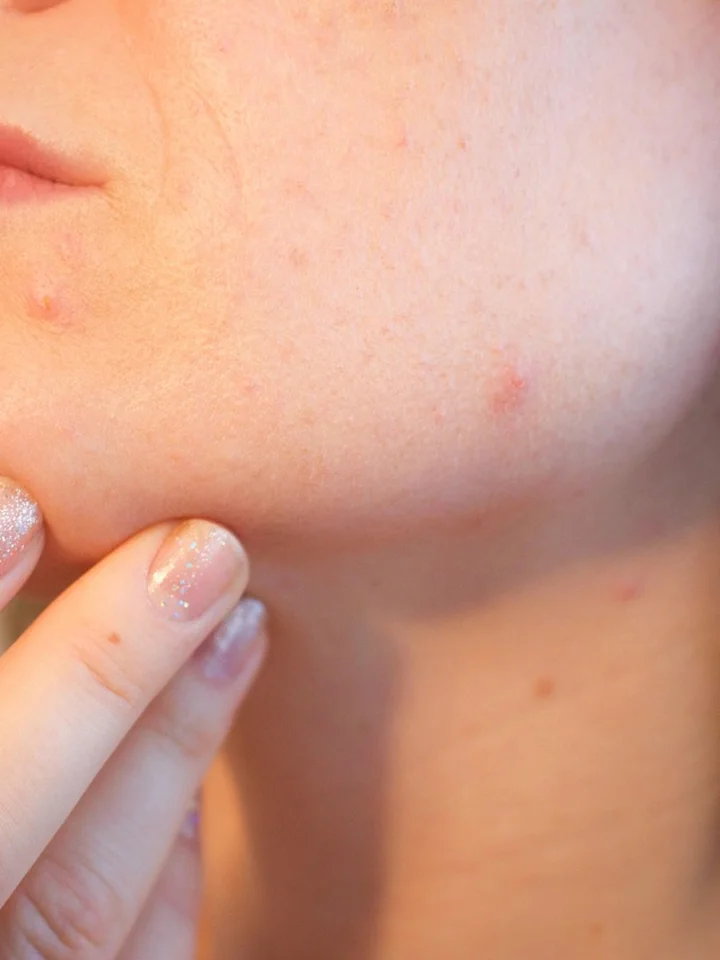 Adapalene Gel for Acne: A Practical Guide to How It Works
