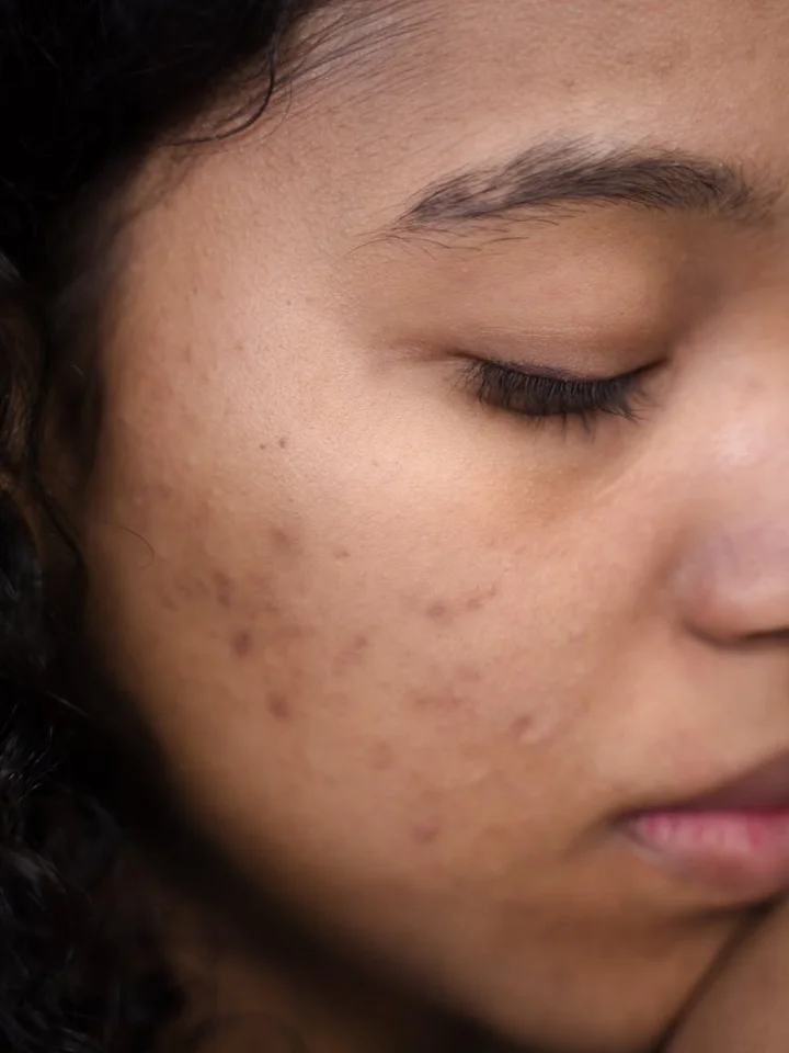 Close-up of a person's face showing acne and uneven skin texture.