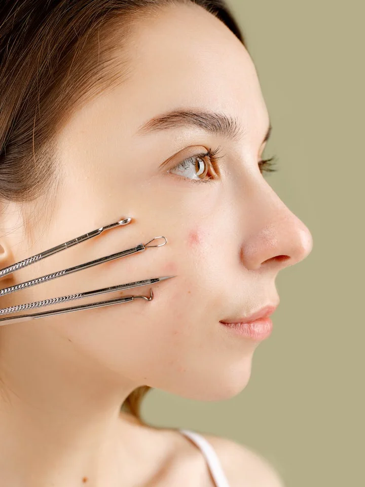 Close-up side profile of a woman with mild facial acne, with dermatology tools resting against her cheek.