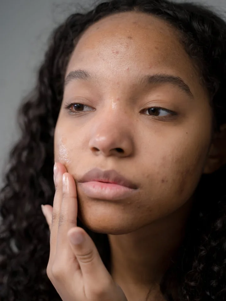 Close-up of a young woman touching her cheek, examining acne-prone skin.