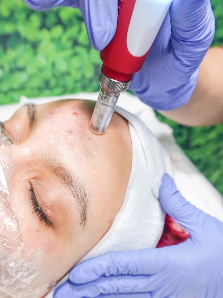 Clinician wearing purple gloves performing a facial treatment on a patient, applying a red handheld device to the cheek.