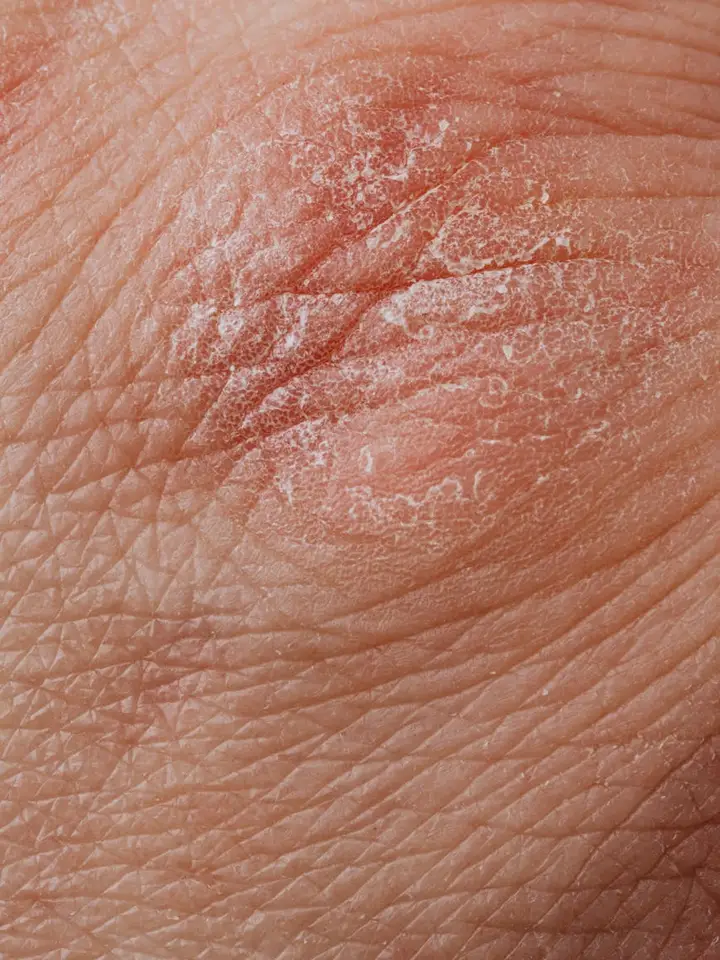 Close-up of dry, flaky skin with visible wrinkles on a fingertip.
