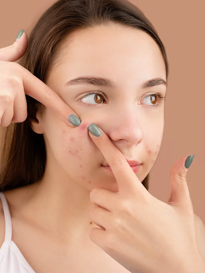 Close-up portrait of a young woman examining acne on her cheek while pointing to a blemish to illustrate pores and clogged follicles.