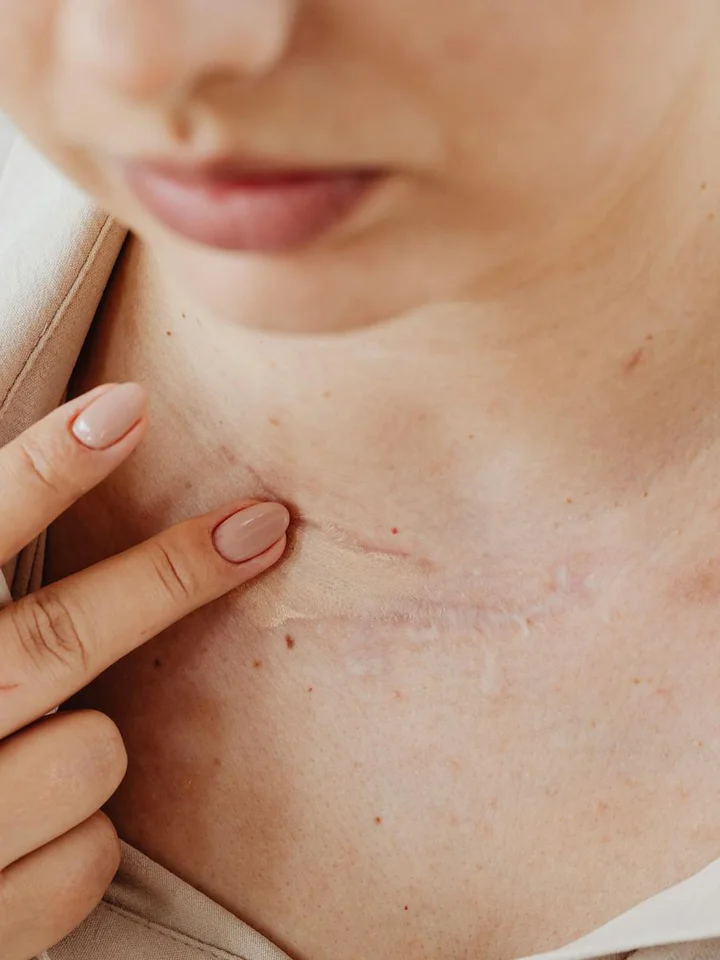 Acne-Prone Skin? We Compare NARS, Fenty Beauty, and Clinique Concealers for Clog-Free Coverage