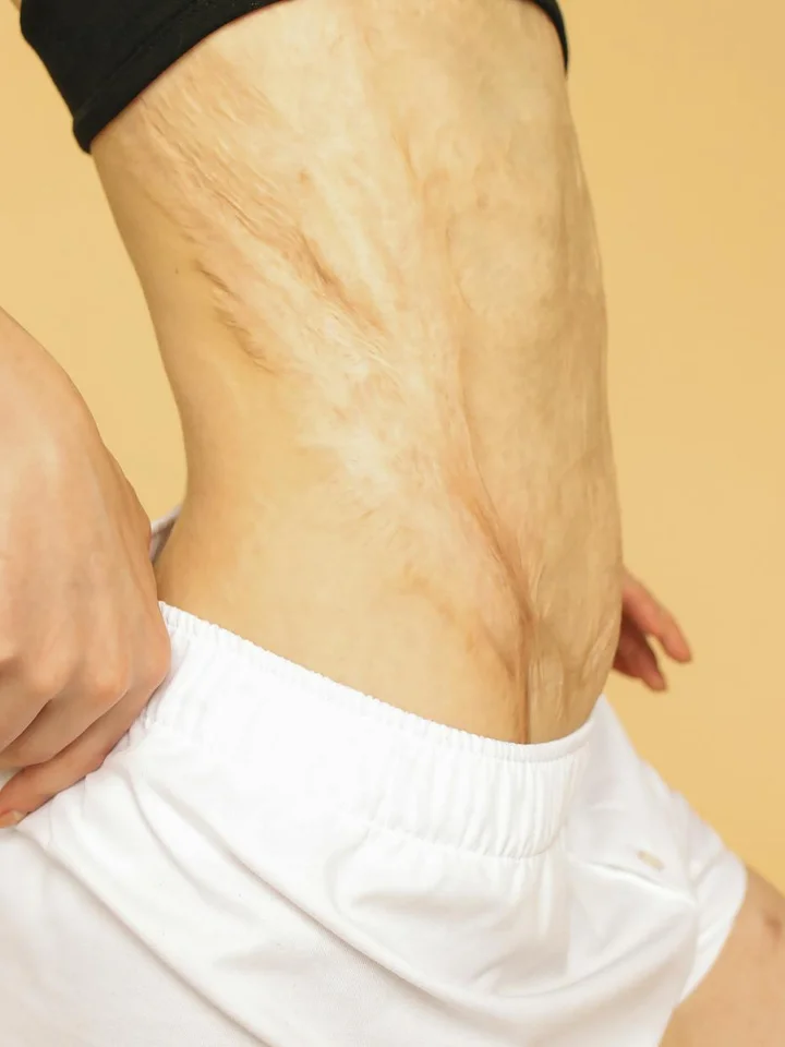 Close-up of a midsection with stretch marks on the abdomen.