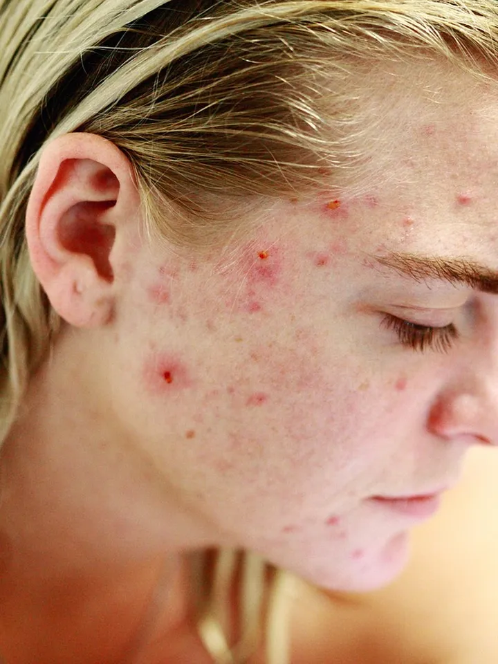 Mixing Tretinoin and Adapalene: A Clear Guide to Safety and Results
