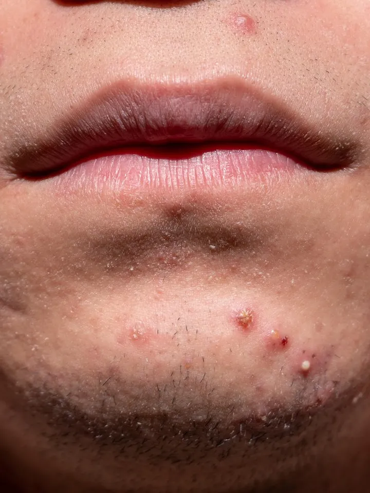 Adapalene vs. Differin: Finding Your Path to Clear Skin