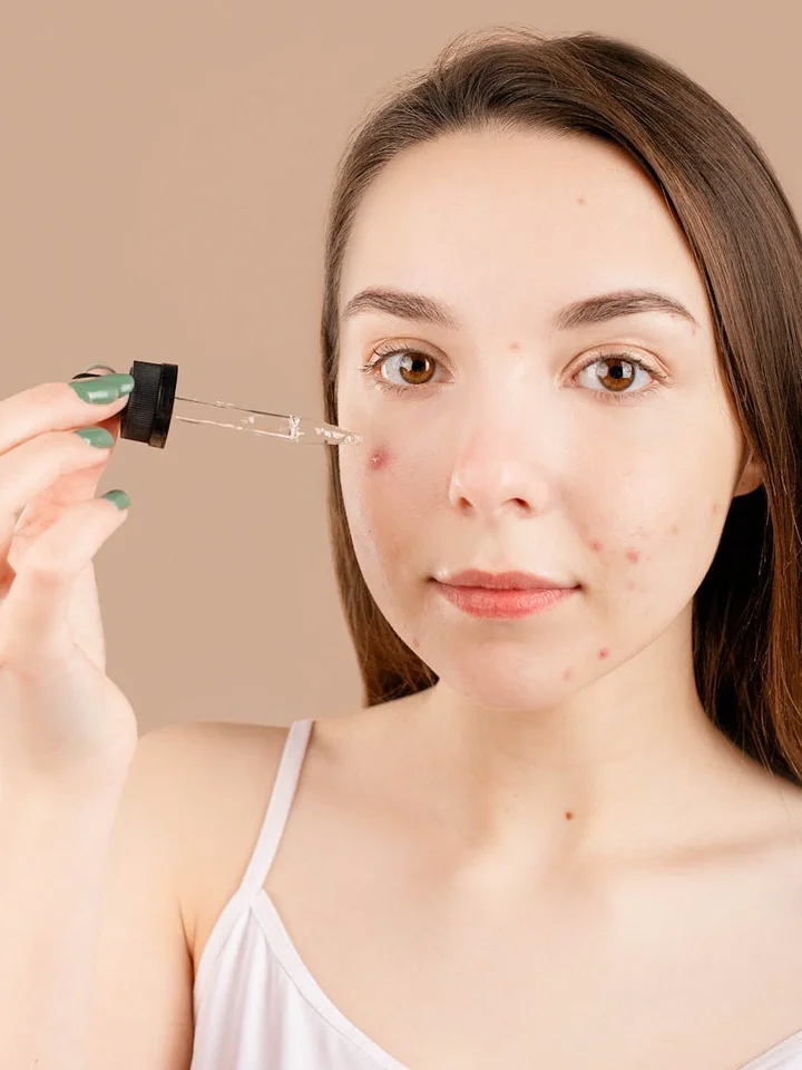 Close-up of a young woman with mild acne applying a skincare serum using a dropper to her cheek.