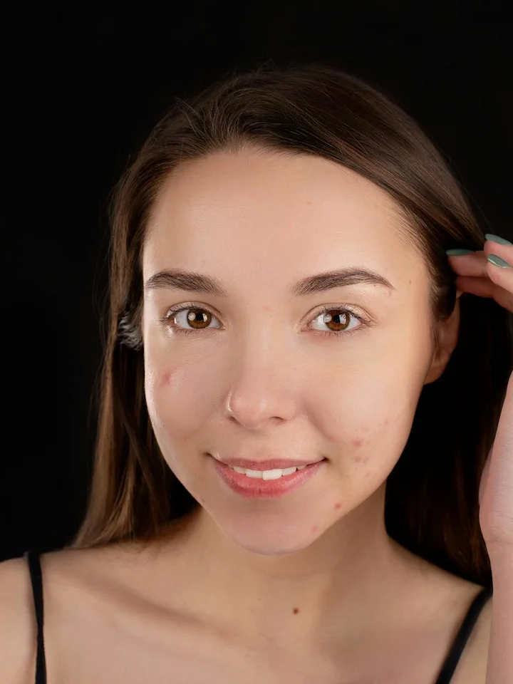Close-up portrait of a young woman with mild acne on her cheeks and chin, posing against a dark background.