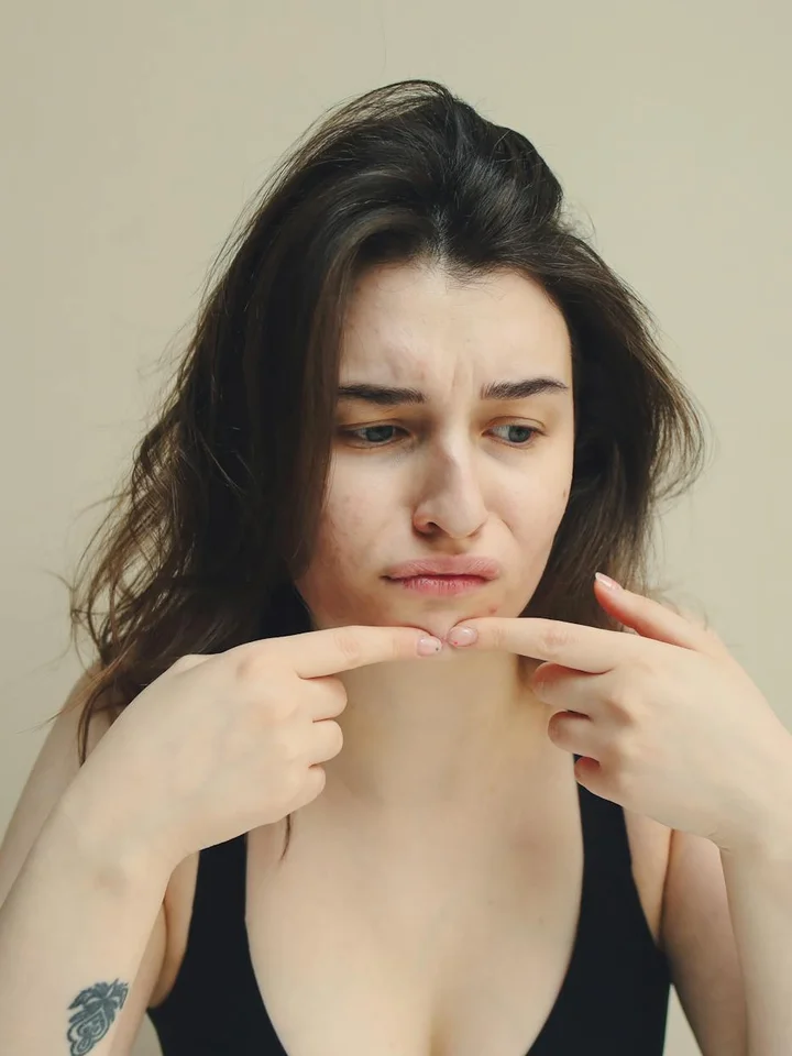 A woman with dark hair examines her chin with a concerned expression, pointing to acne-prone areas.