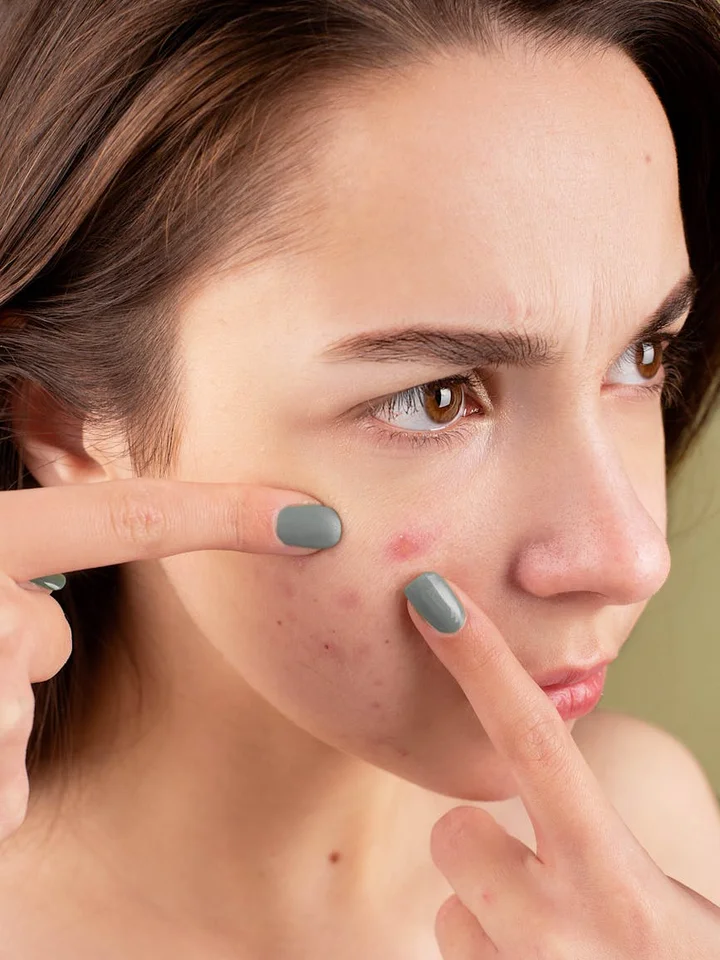 Close-up of a person examining a blemish on their cheek with two fingers pointing at the acne.