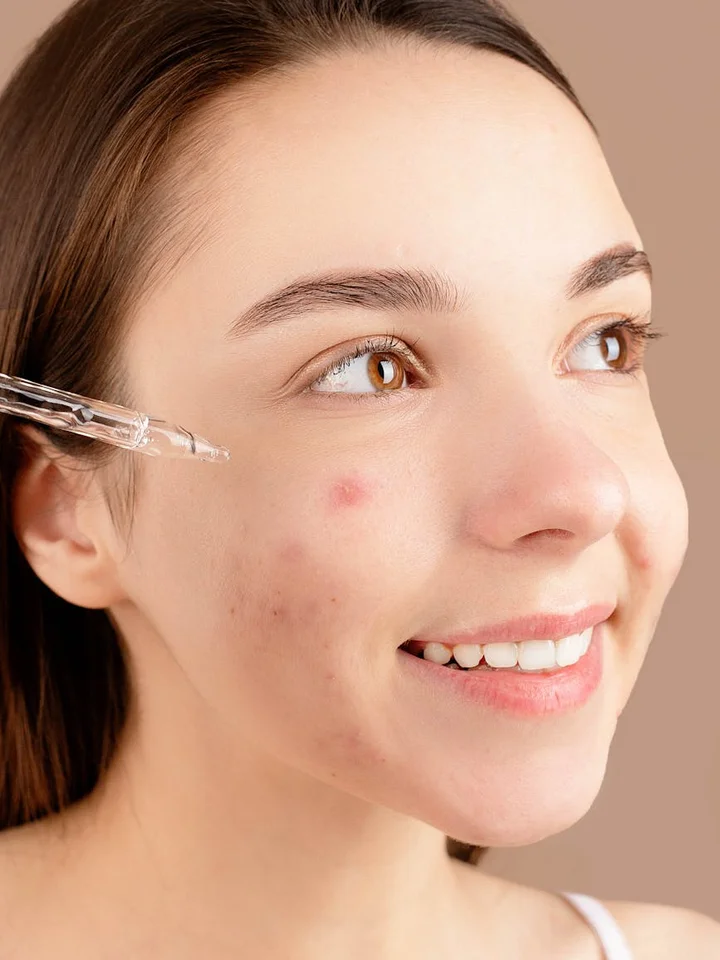 Close-up of a smiling woman with a dropper near her cheek as part of a skincare routine, illustrating topical acne treatment
