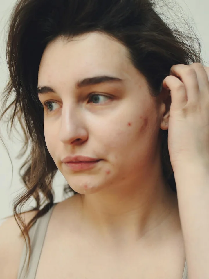 Close-up portrait of a young woman with mild acne looking to the side.
