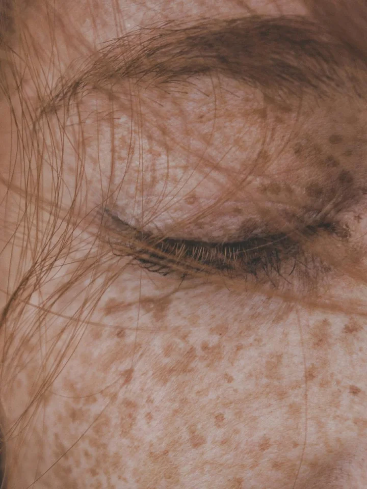 Close-up of an eye area showing hyperpigmentation freckles and fine lines around the eyelid