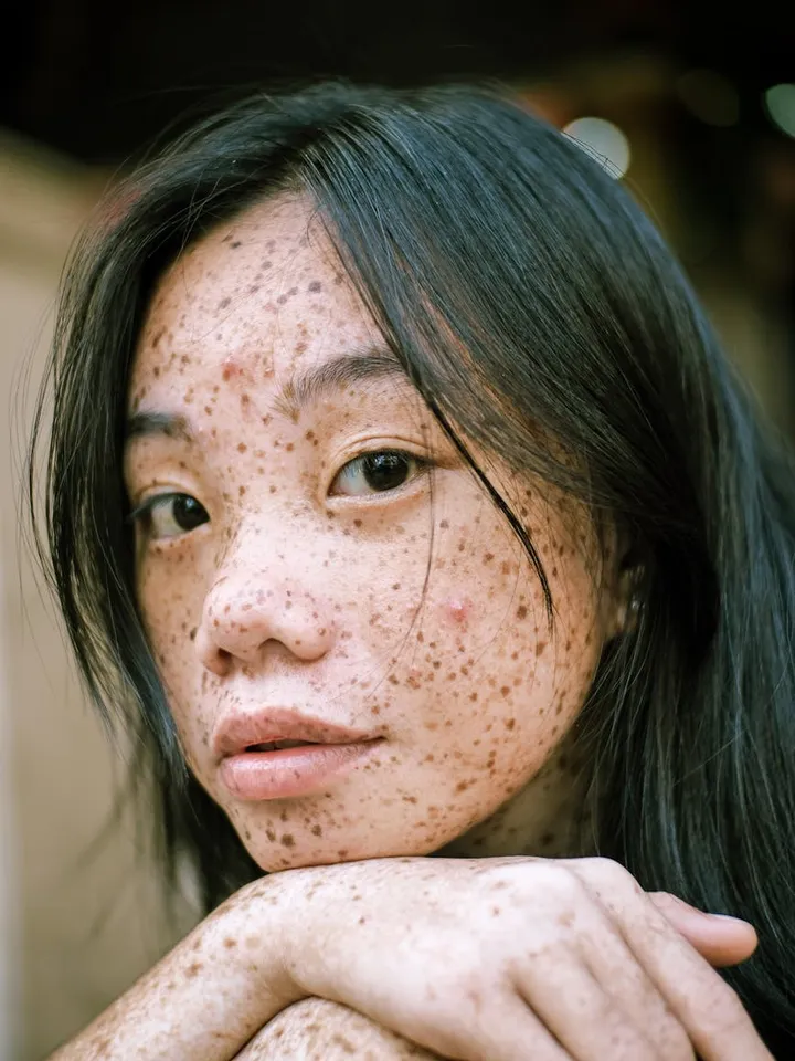 Close-up portrait of a person with freckled skin and dark hair.