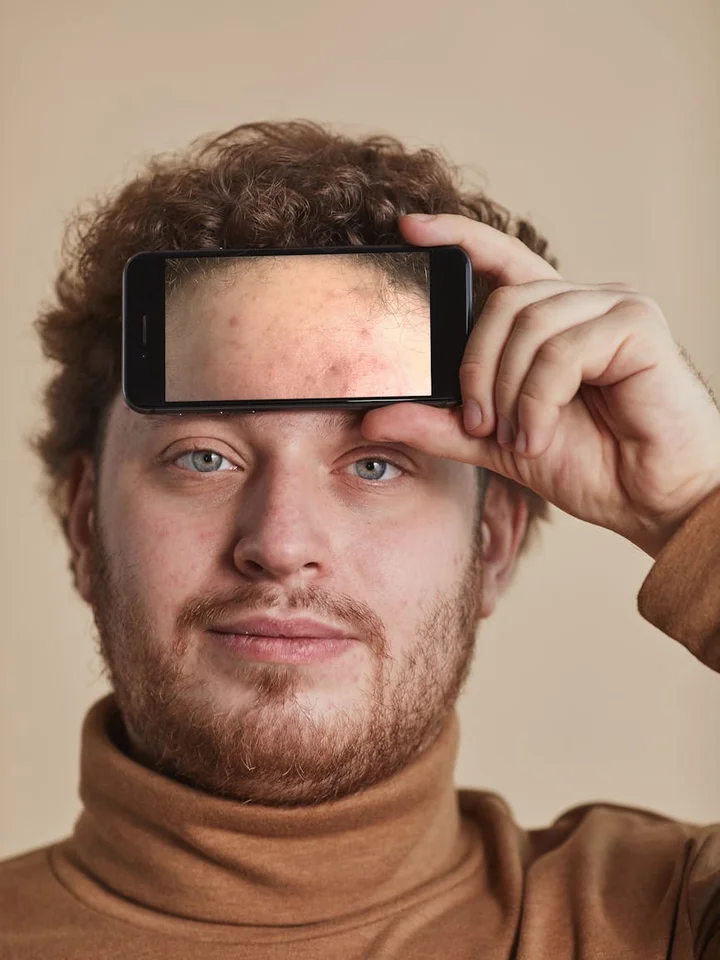 Portrait of a man holding a smartphone to his forehead to reveal acne-prone facial skin.