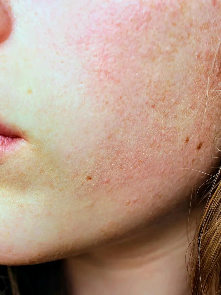 Close-up of a cheek showing mild hyperpigmentation and redness, illustrating dark spots on the skin
