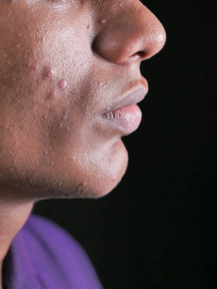 Close-up image of a person’s lower face showing acne and blemishes on the cheek.