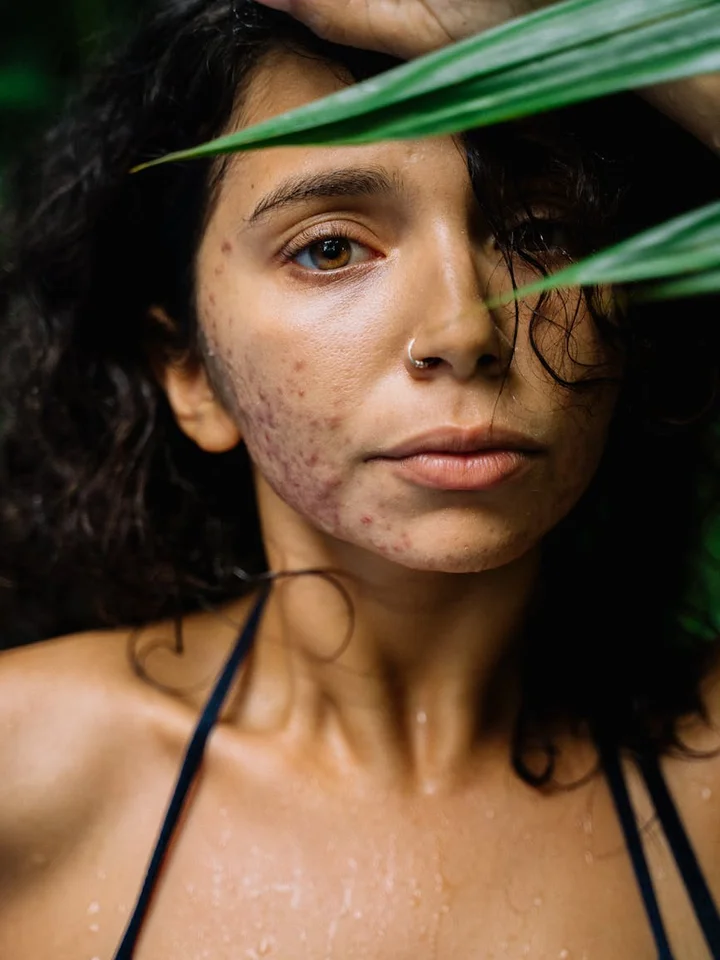 Mixing Benzoyl Peroxide and Azelaic Acid for Acne: A Clear, Safe Guide