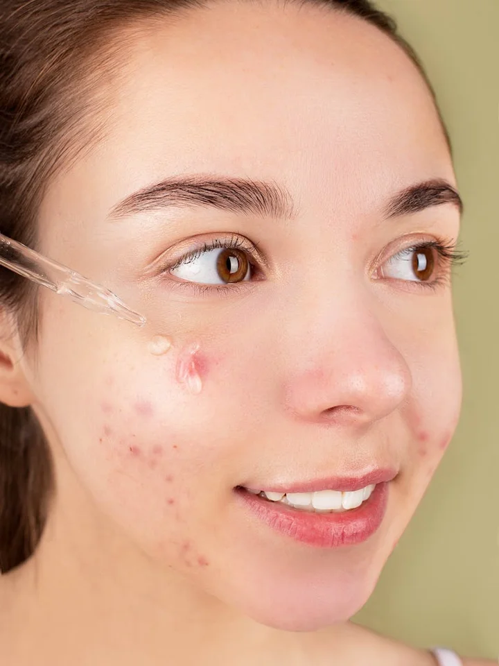 Close-up of a young woman with acne-prone skin applying serum with a dropper to her cheek
